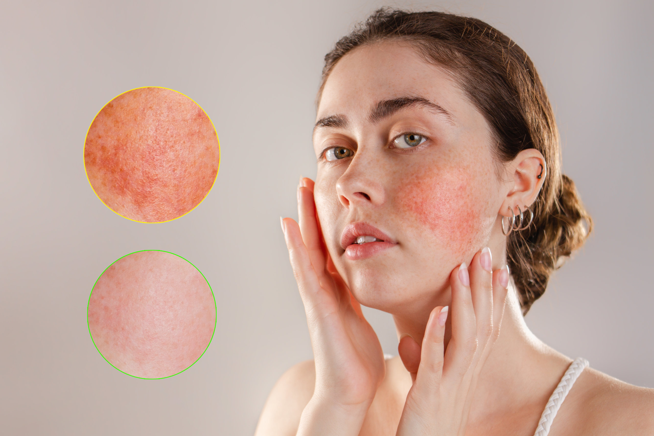 Medicine and cosmetology. Portrait of a young beautiful brunette woman with rosacea on her cheeks. Enlarged images of inflammation foci. Before and after